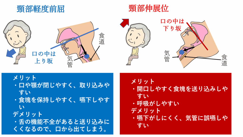 嚥下しやすい軽度前屈位と誤嚥しやすい頸部伸展位の違い。頭頚部の角度が飲食物の通り道に与える影響の図解。